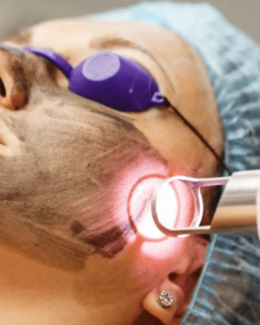 Advanced Under-Eye Rejuvenation with Laser Therapy at Cinch Clinics